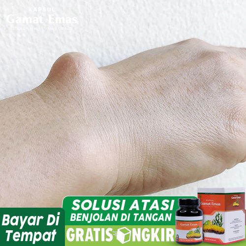 Obat Benjolan Di Tubuh, Benjolan Di Tangan, Benjolan Di Kaki, Benjolan ...