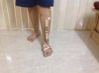 สายรัดพยุงปลายเท้า  Foot sling (S,M,L)