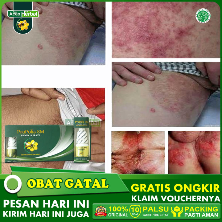 Obat Gatal Selangkangan Menghitam Infeksi Jamur Kulit Kutil Kelamin