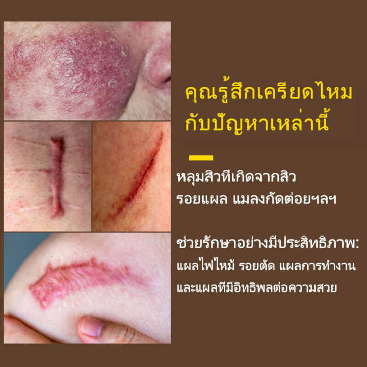 ครีมลดรอยแผลเป็น-ครีมรักษาแผลเป็น-ครีมซ่อมแซมรอยแผลเป็น-scar-removal-cream-ครีมซ่อมแซม-รักษาแผลเป็น-แผลไฟไหม้-แผลผ่าตัด-แผลน้ำร้อนลวก