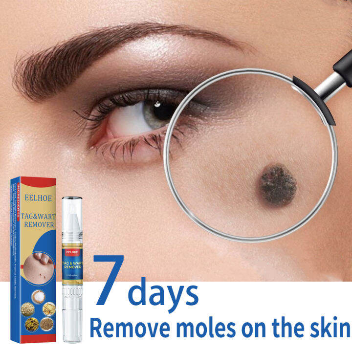 Original Wart and Mole Remover Skin Tag Removal Pen Warts Remover Tool ...