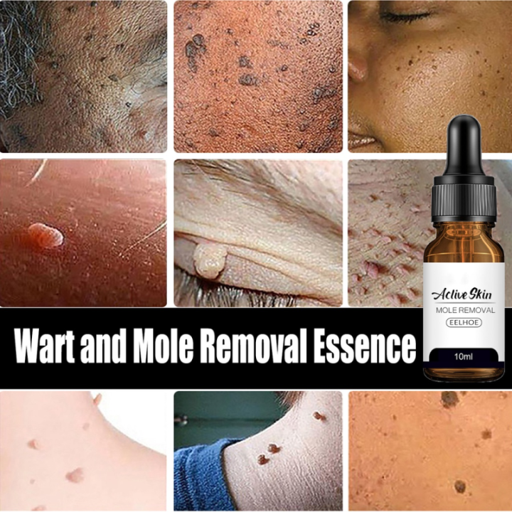 zx-beauty-shop-mole-removal-essence-skin-tag-remover-mole-amp-genital-wart-removal-antibacterial-liquid-painless-mole-skin-dark-spot-remover-serum-face-wart-tag-removal-solution