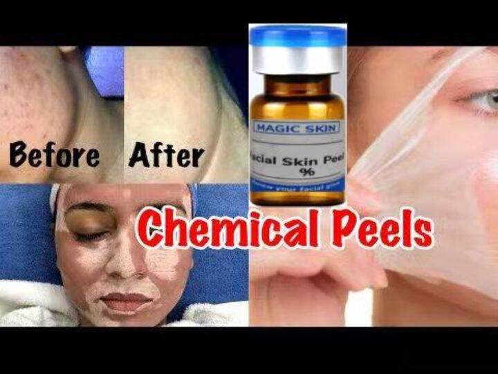 EBOBO KIT 50 Glycolic Acid Chemical Peel Neutraliser Anti Wrinkle Remove Dark Spots Face