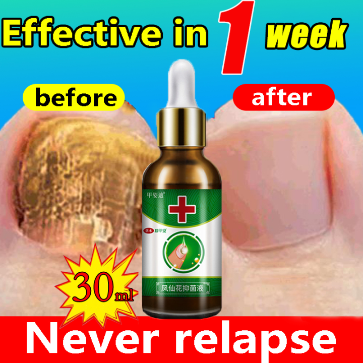 Nail fungus repair Nail repair liquid 30ml Quickly repair damaged nails