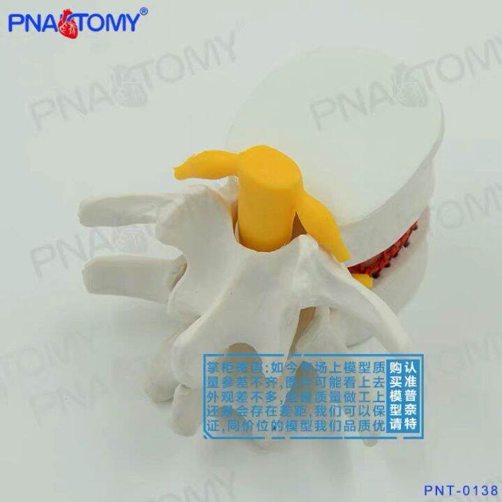 model-of-lumbar-intervertebral-disc-human-intervertebral-disc-extrusion-spine-vertebra-bone-anatomy-medical-teaching-demonstration-teaching-aids