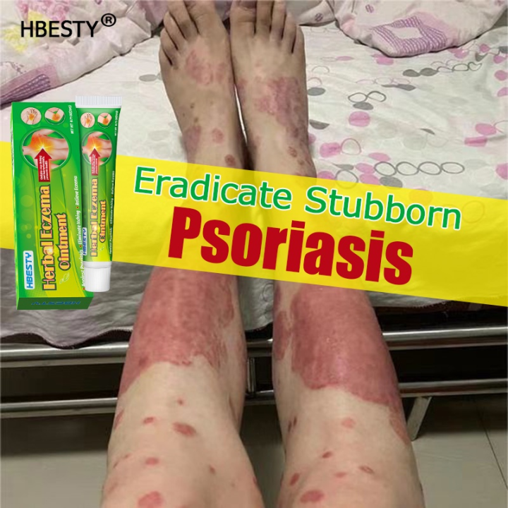 100 Effective Psoriasis Ointment Psoriasis Eczema Cream Psoriasis