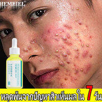 HEMEIEL เชรั่มหน้าใส/ครีมกำจัดสิว/Vitara Acne Gel