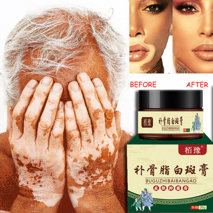 Chinese Herbal Extract Vitiligo Treatment Cream Vitiligo Repair Cream
