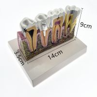 Dental Caries Anatomy Comprehensive Pathology Tooth Nerve Tooth Model For Oral Teaching Teeth Model