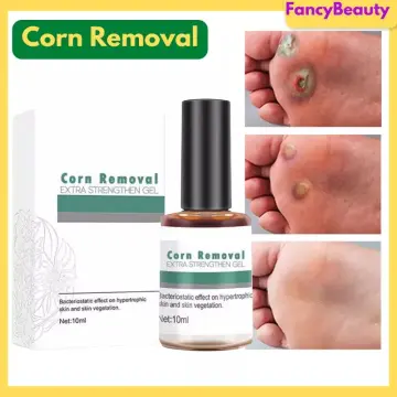 Foot Corn Removal,Extra Strengthen Gel Quick Corn Remover Liquid Mild Corn  Callus Remover for Feet
