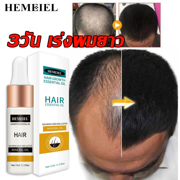 hemeiel-ที่เร่งผมยาว-ครีมเร่งผมยาว-บำรุงผมยาวเร็ว-ป้องกันผมร่วง