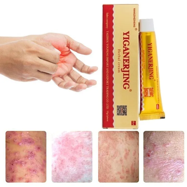 Psoriasis Dermatitis Cream Natural Herbal Cream Relief Itching Eczema ...