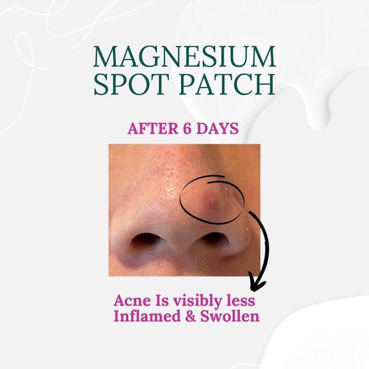 jyunka-magnesium-spot-patch-แผ่นแปะสิว-สิวอักเสบ