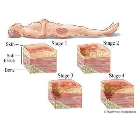 เบาะรองขารักษาแผลกดทับที่ต้นขา-หมอนรองขา-mybow-knee-pillow-leg-แผลกดทับ-ขาเข้าเฝือก-หมอนรองขาสำหรับขาเจ็บขาบวม-รูปร่างนวดสนับสนุนหมอนร่างกาย-หมอนรองขา-knee-pillow-leg-เบาะรองขา-เบาะรองนอน-cushion-หมอน