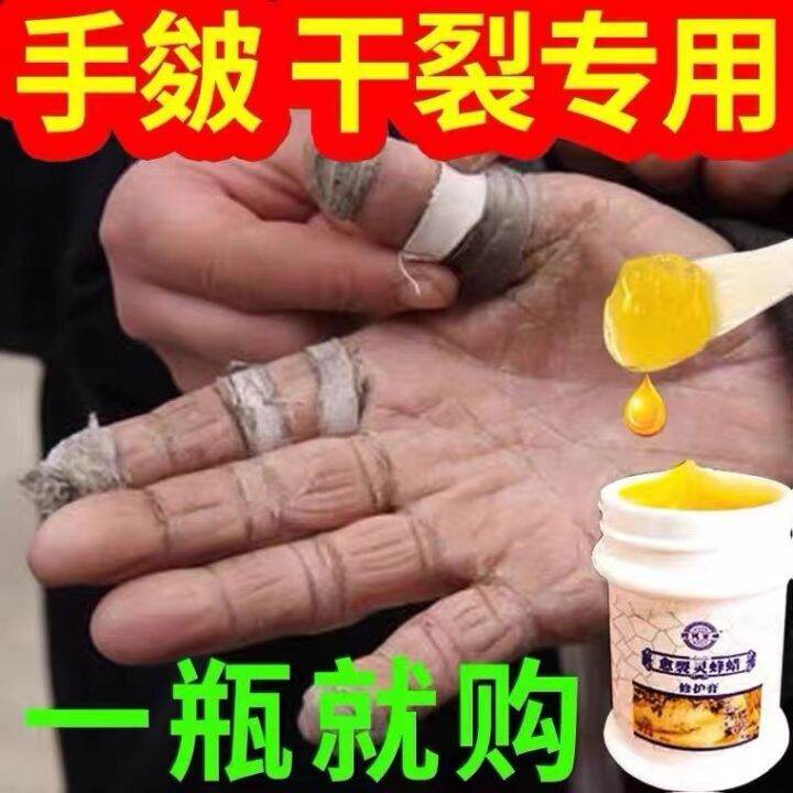 Ointment for cracked hands [100 smelting] cracked hands and feet