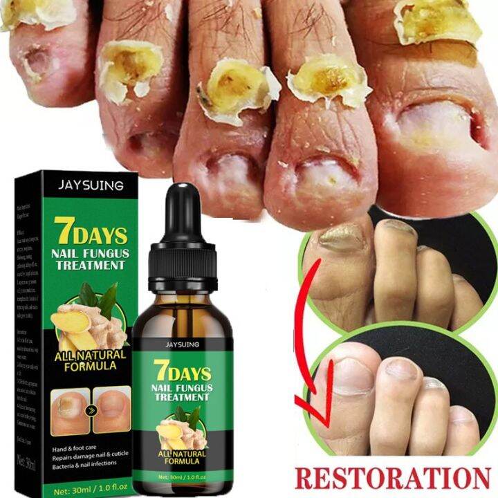 7 DAYS Nail Fungus Treatments Essence Onychomycosis Paronychia Anti ...