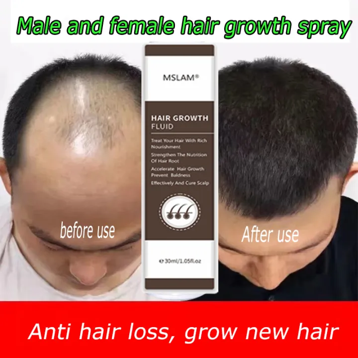 MSLAM Hair Growth Spray,Hair Growth Serum Moisturize The Scalp,Repair Hair  Roots,Stimulate Hair Follicles, And Grow Thick And Lush New Hair  Effectively Rapid Hair Growth Prevents Hair Loss | Lazada PH