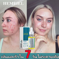 HEMEIEL เจลละลายสิว/ลดสิว รอยสิว/Retinal A