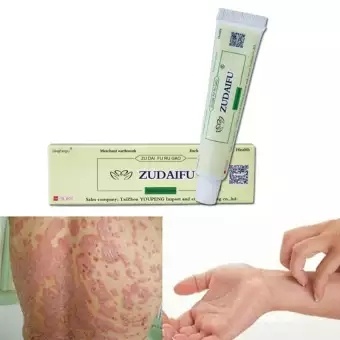 Hcmzudaifu natural chinese herbal medicine cream eczema dermatitis - ảnh sản phẩm 7