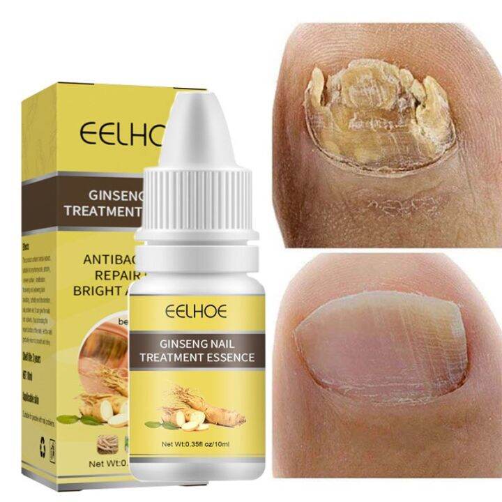 Ginseng Nail Fungal Treatment Essence Foot Nail Fungus Removal Repair ...