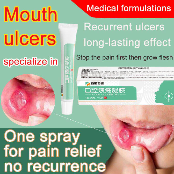 mouth-ulcer-gel-ointment-mouth-fire-blister-tongue-blister-congestion