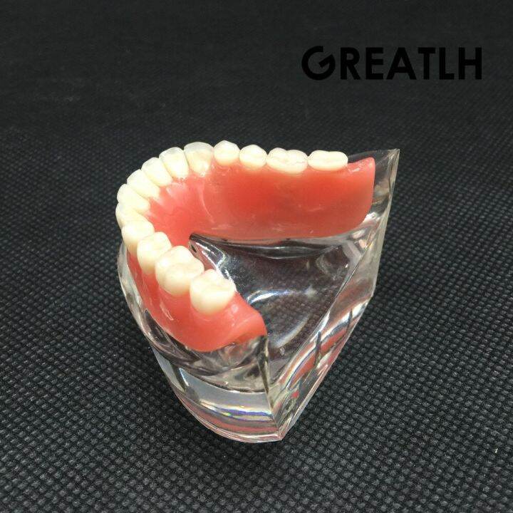 dental-overdenture-interior-mandibular-lower-teeth-model-mandibular-with-implant-restoration-tooth-dental-teaching-study