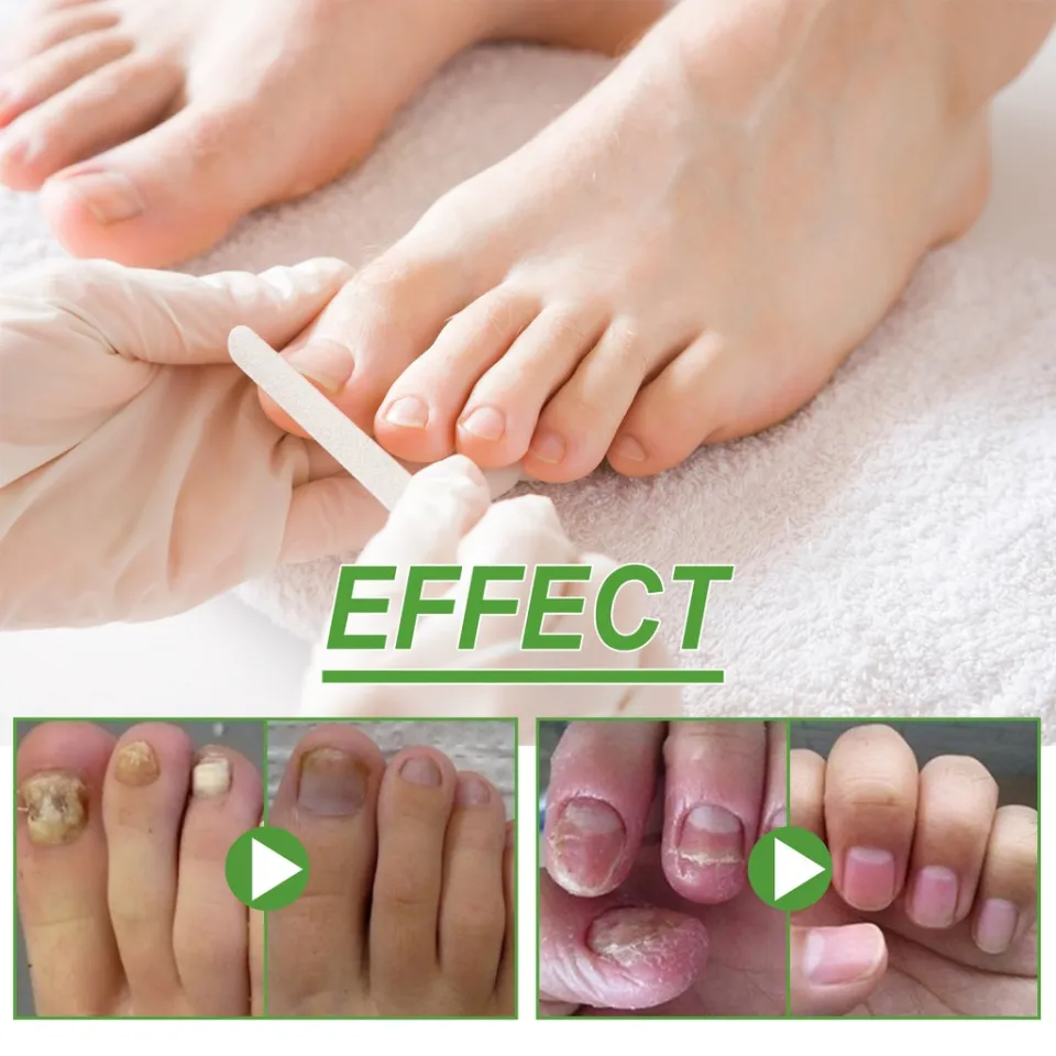Sally Hansen - Nailgrowth Miracle® Growth Treatment, promotes nail gro –  Zecoya