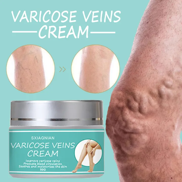 Varicose Vein Cream Natural Reduce Swelling Relieve Pain for Vasculitis ...