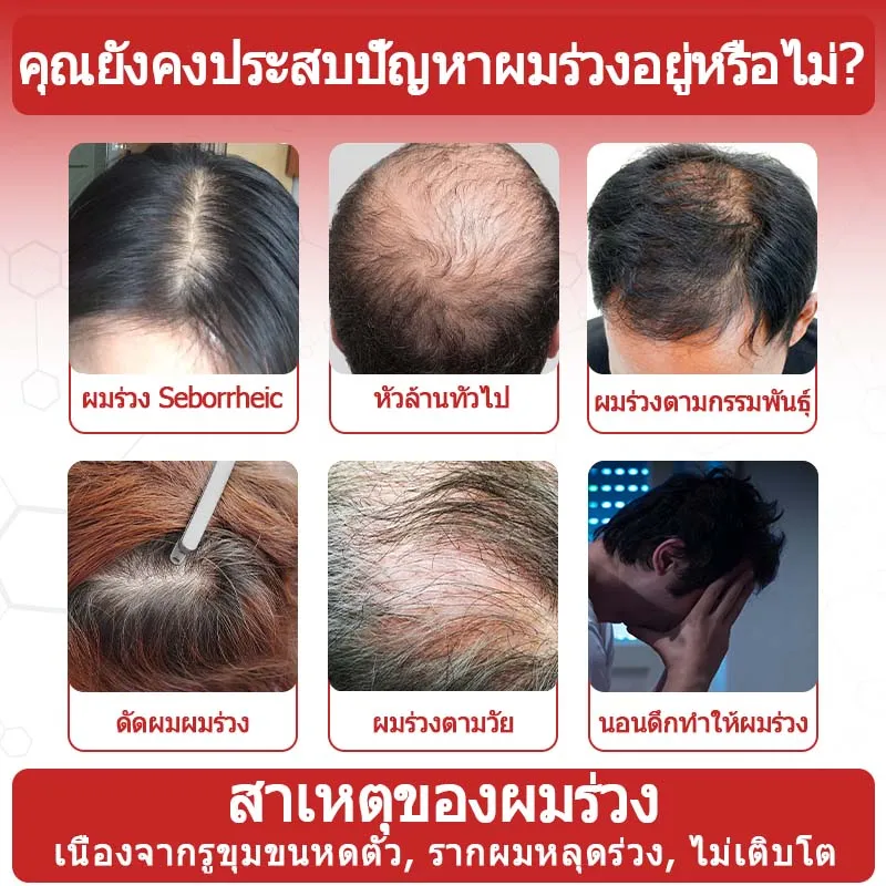 Roiciao Hair Regrowth Treatment 5% Minox เซรัม ผมร่วง หัวล้าน ปลูกผม  ปลูกหนวด สำหรับผู้ชาย 60 Ml | Lazada.Co.Th