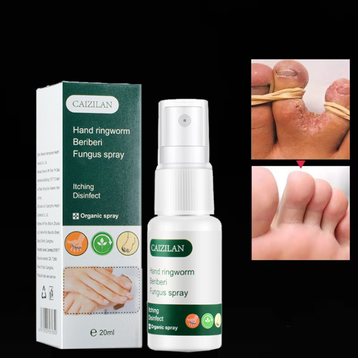 Herbal ringworm foot spray hand and foot fungus remover 20ml anti ...