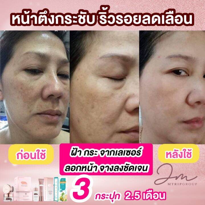 ครีมฝ้า-jolasma-ลด-จุดด่างดำ-ริ้ว-รอย-ฝ้า-กระ-2-กระปุก