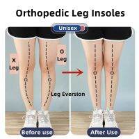 ซิลิโคนOrthopedic InsolesสำหรับฟุตO/XประเภทขาValgus Varus Correction Plantar Fasciitisเจลพื้นรองเท้าแม่เหล็กนวดเท้าcare-Giers