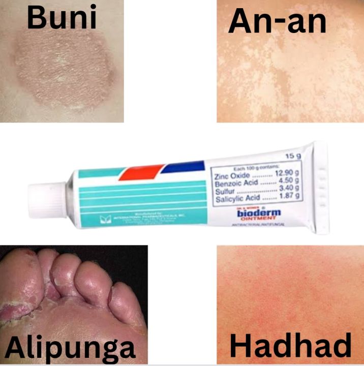 Anti-fungal Cream: Gamot Sa An-an, Buni, Hadhad, Alipunga At Iba Pa 5g ...