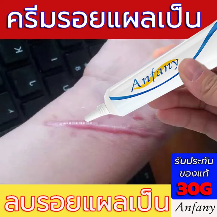 ครีมลบแผลเป็นanfanyครีมทาแผลเป็น30g ครีมลดรอยแผลเป็น ครีมลดรอยสิว เจลลบรอยแผลเป็น ครีมลดแผลเป็น