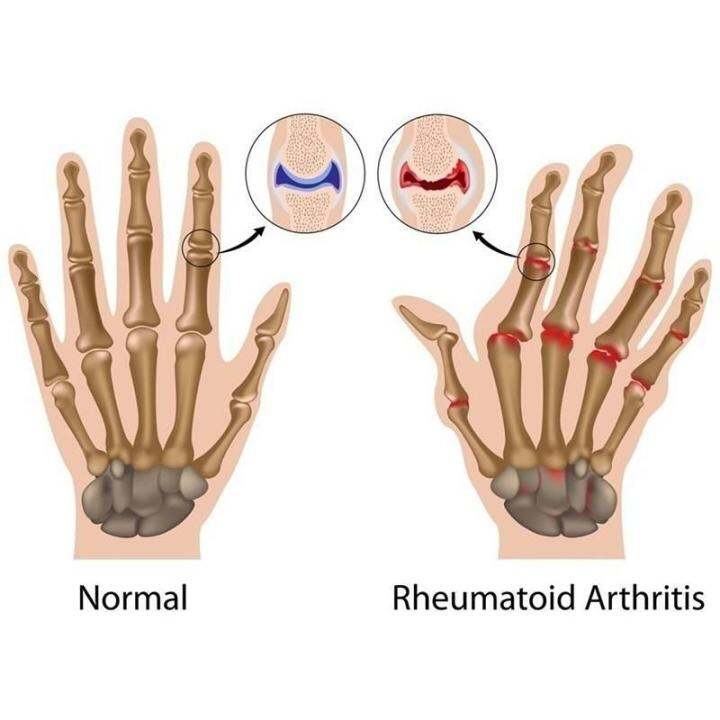 ถุงมือแม่เหล็ก-ช่วยการไหลเวียนโลหิตและบรรเทาอาการบาดเจ็บ-rheumatoid-hand-pain-การรักษาด้วยการบีบอัดด้วยความร้อน-ถุงมือปั่นจักรยาน-ปีนเขา-ตีแบต