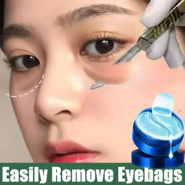 Aggregate 131+ eye bag removal philippines cost super hot