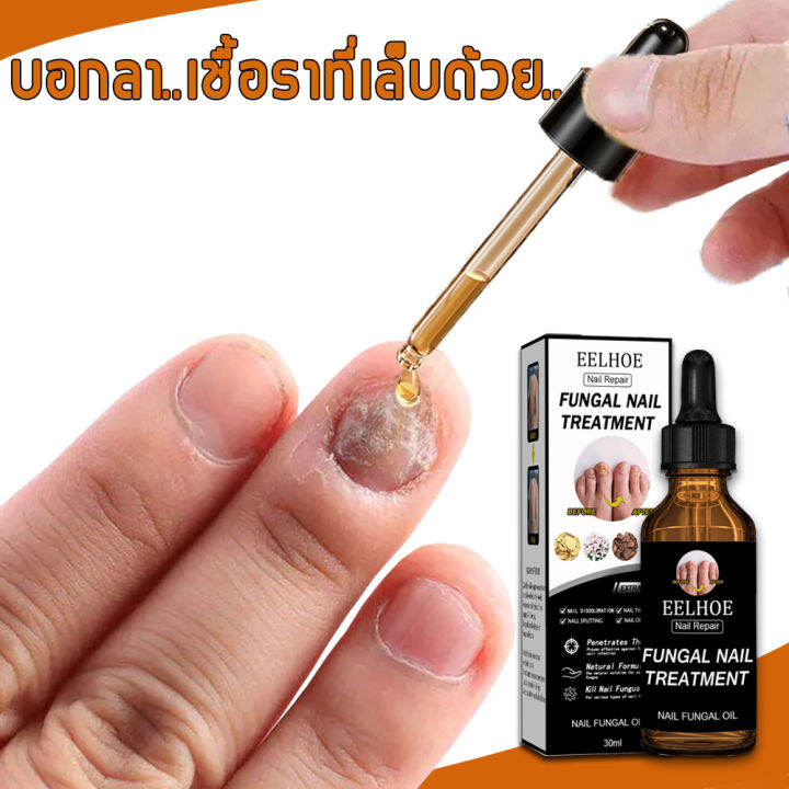 เซรั่มซ่อมแซมเล็บ Nail Fungus Medicine ซ่อมแซมเล็บเสีย กำจัดเล็บเสีย  บำรุงเล็บเสีย ยาแก้เชื้อราที่เล็บ ยากันเชื่อราเล็บ（เซรั่มบำรุงเล็บ น้ำมันบำรุงเล็บ  ยาทาเชื้อราที่เล็บ เชื้อราเล็บมือ เซรั่มเชื้อราเล็บ น้ำยาเล็บขบ ยา ฆ่าเชื้อราที่เล็บ บำรุงเล็บ ...