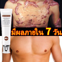 [ซื้อ 2 แถม 1] ครีมลดรอยแผลเป็น VG ครีมแผลเป็น เห็นผลใน 3 วัน ครีมทารอยแผลเป็น ขจัดรอยแตกลาย น้ำร้อนลวก แผลไฟไหม้ บาดแผล และซ่อมแซมผิวที่เสียหาย ครีมฟครีมรักษาคีลอย remove scar cream