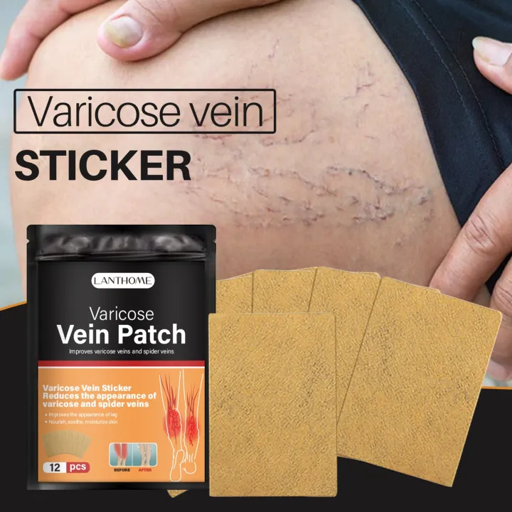 12Pcs Varicose Vein Patch Leg Sore Swelling Relief Plaster Venous ...