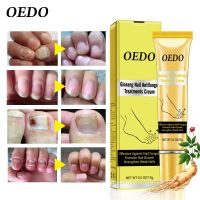 2pcs OEDO Ginseng Fungal Nail Treatment Cream Removal Onychomycosis Nail Repair Essence Repair Damaged Nails Antifungal Care Gel