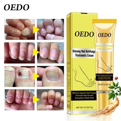 2pcs OEDO Ginseng Fungal Nail Treatment Cream Removal Onychomycosis Nail Repair Essence Repair Damaged Nails Antifungal Care Gel