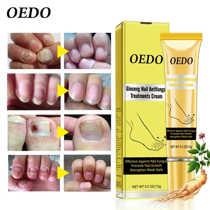 2pcs-oedo-ginseng-fungal-nail-treatment-cream-removal-onychomycosis-nail-repair-essence-repair-damaged-nails-antifungal-care-gel