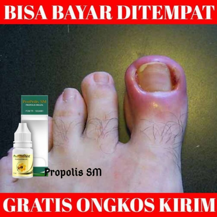 Obat Cantengan Cantengan Jempol Kaki Cantengan Tangan Cantengan