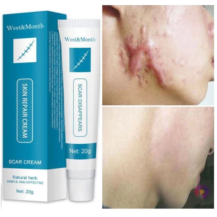 Medona 20g Herbal Scar Repair Cream Herbal Acne Scars Remove Gel Fade Stretch Marks Acnes Spots 1012