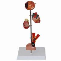 Authentic medical diabetes model heart model atherosis kidney model