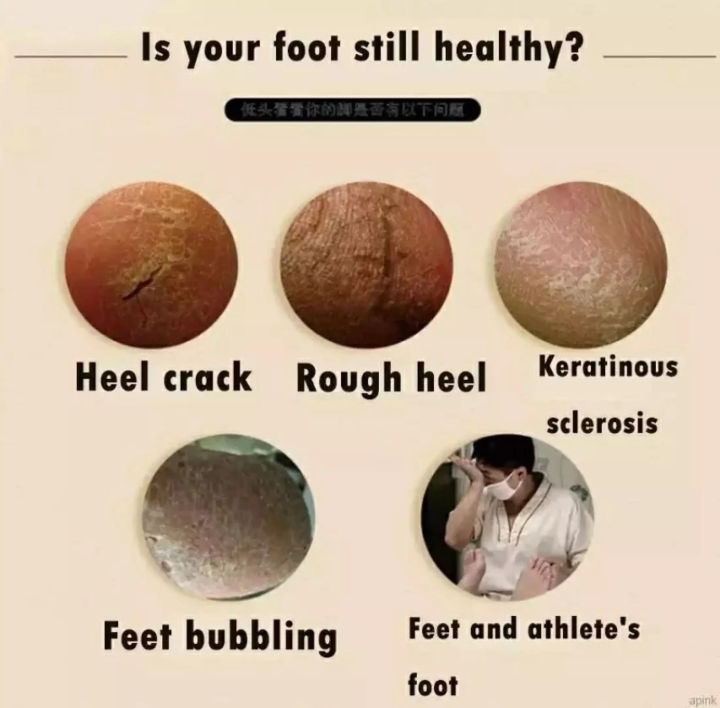 แนะนำโดยคุณหมอjlisa-น้ำมันม้า-ครีมทาเท้า-ครีมบำรุงเท้า-ครีมทาเท้าแตก-ผิวหยาบกร้าน-ยาทาเท้าแตกซ่อมแซมรอยแตก-เป็นขุยและผิวยบสำหรับเท้า