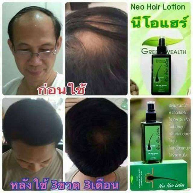 neo-hair-lotion-ของแท้-1-แถม-1-เซรั่มปลูกผม-นีโอแฮร์โลชั่น-neohair-นีโอแฮร์-ของแท้-1-ขวด-แถม-1-ขวด