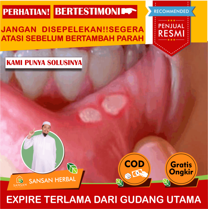 Obat Sariawan Di Apotik , Obat Sariawan , Obat Sariawan Anak , Obat ...