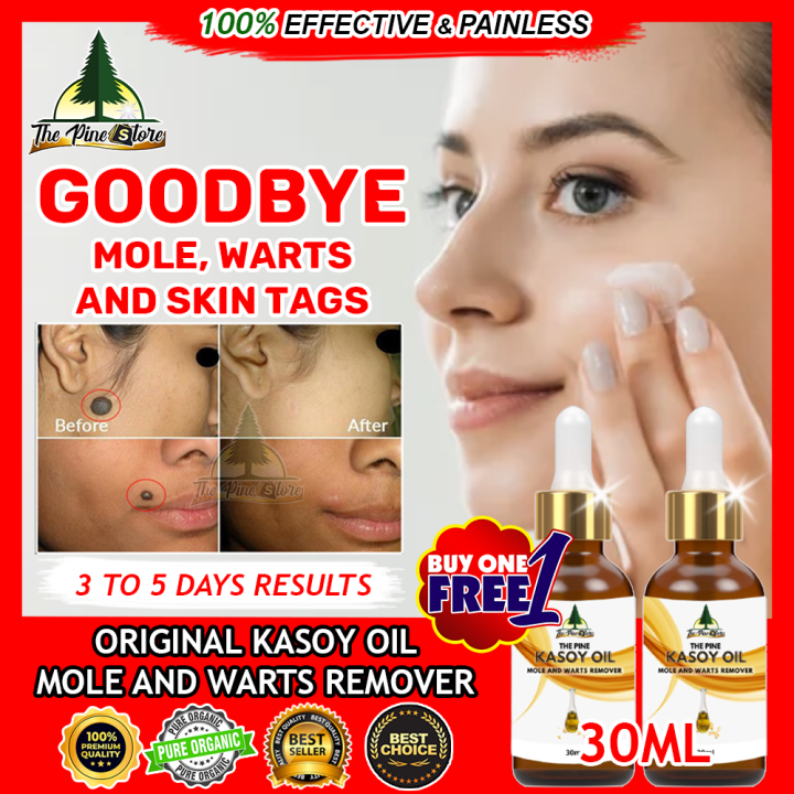 💛 Kasoy Oil 30ML 100% Effective Mole Remover Wart Remover Buy 1 Take 1 ...