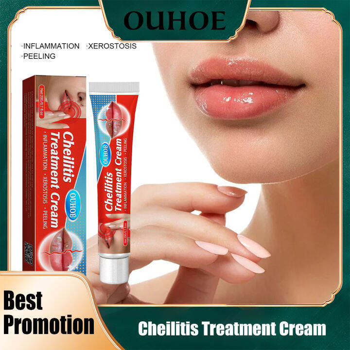 Ouhoe Cheilitis Treatment Cream Inflammation Labial Herpes Antibacterial Ointment Chapped Lips 9890